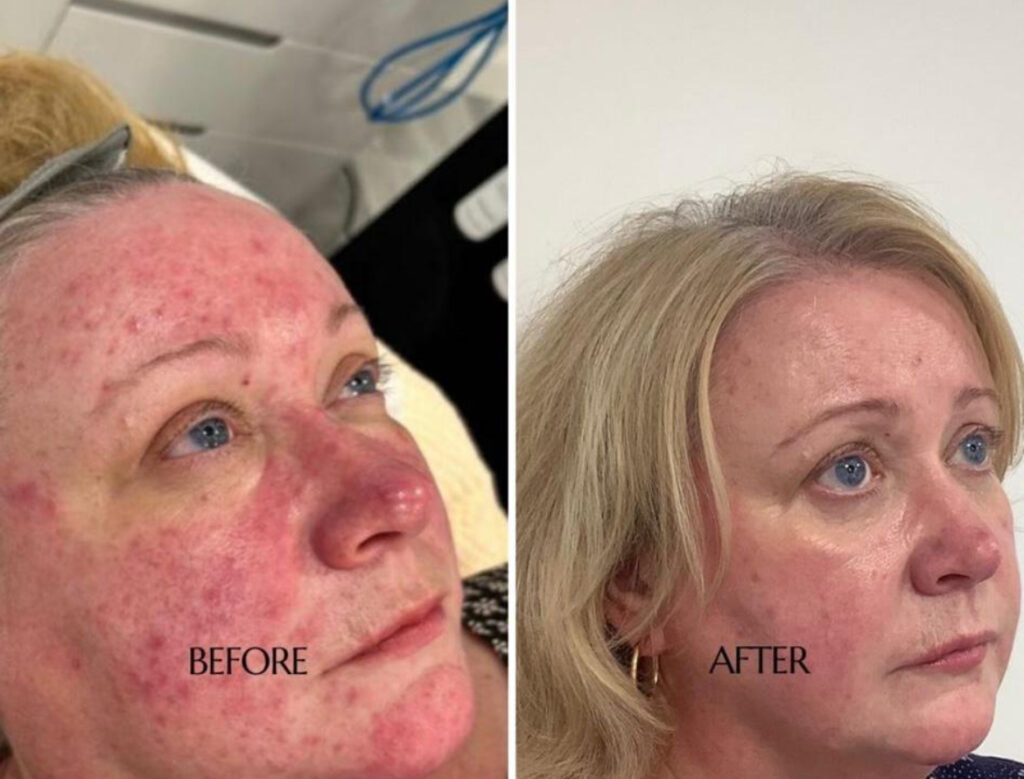 LUMECCA, DERMALUX AND ZO