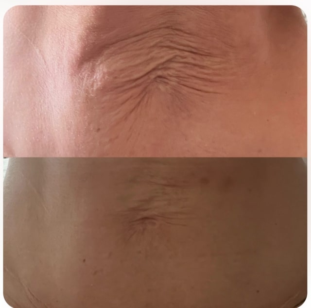 Morpheus8 at NY Skin Clinic in Aberdeen