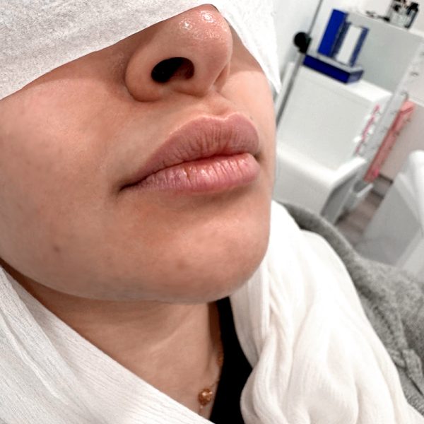 Lip Filler - NY Skin Clinic 2